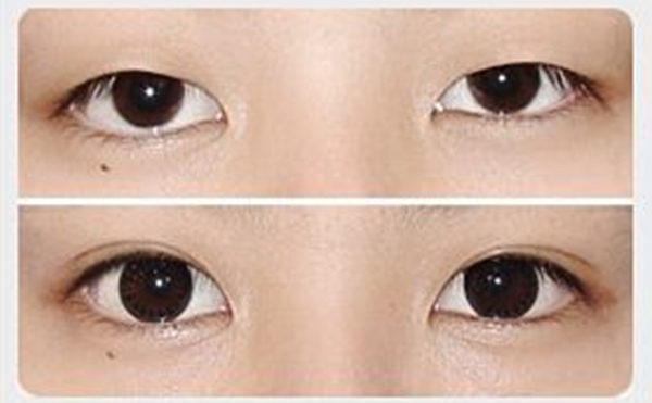 割雙眼皮和開眼角可以同時(shí)進(jìn)行嗎?一共多少錢?