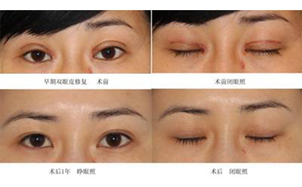 雙眼皮修復(fù)恢復(fù)快嗎?哪些人不適合做雙眼皮修復(fù)?
