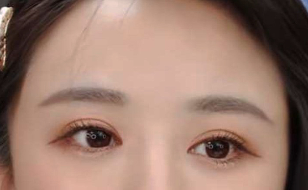 高低眼是怎么造成的?高低眼怎么矯正?