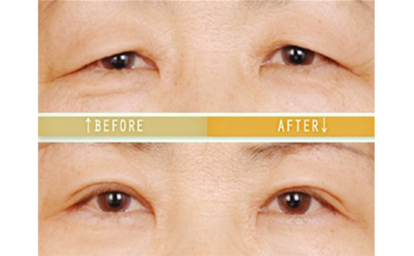 老年人怎么做三角眼矯正?術(shù)后怎么護理?