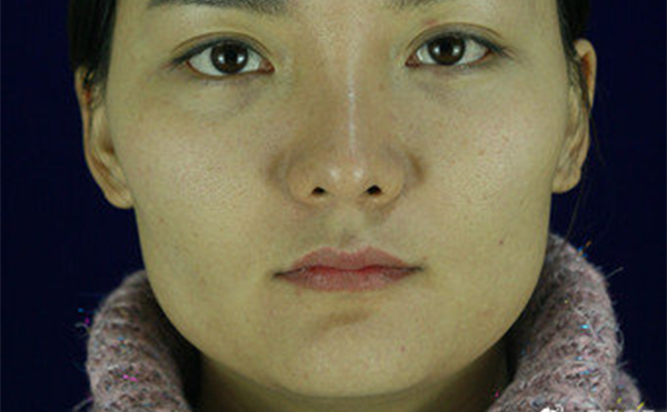 石家莊藍山杜建龍醫(yī)生下頜角整容手術(shù)案例術(shù)前效果