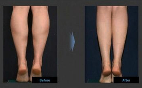 小腿吸脂的原理是什么？