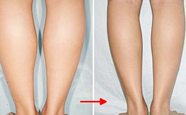 腿部吸脂有什么優(yōu)勢?術(shù)后會反彈嗎?