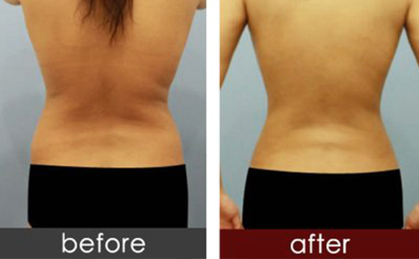 背部吸脂手術(shù)的過程是什么？