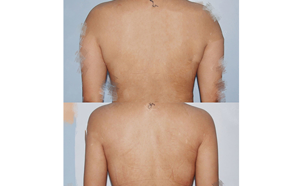 背部吸脂安全嗎？