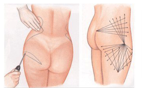 臀部吸脂的手術(shù)過程是什么？