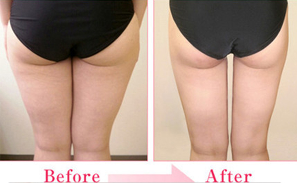 臀部抽脂有什么優(yōu)點(diǎn)？