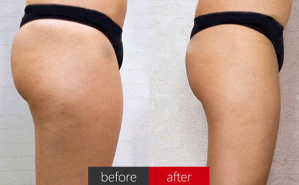 臀部抽脂術(shù)后皮膚會(huì)松弛嗎？