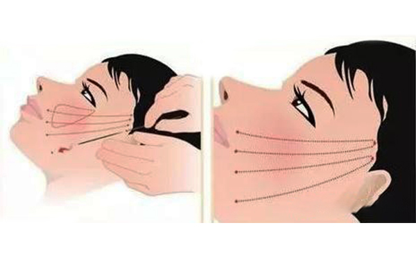 拉皮的原理是什么？