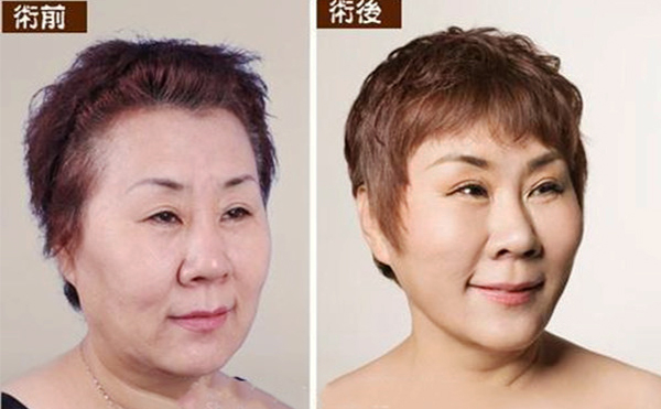 拉皮手術(shù)多久能恢復(fù)自然？