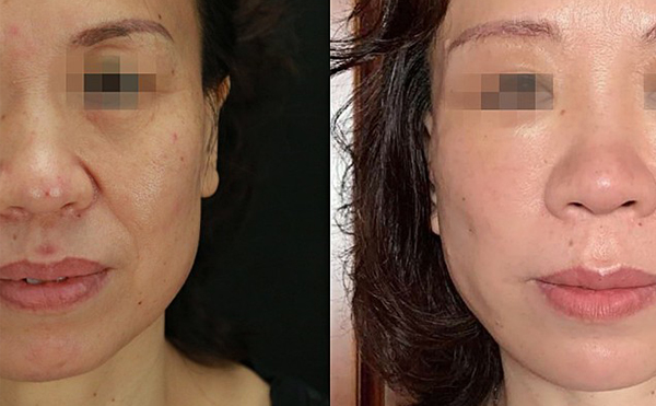 哪些人適合做拉皮手術？