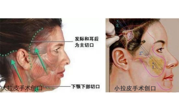 小拉皮和傳統(tǒng)拉皮有什么區(qū)別？