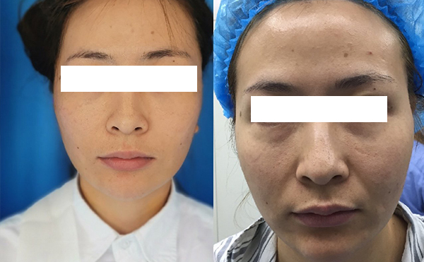 拉皮和線雕哪個效果好？