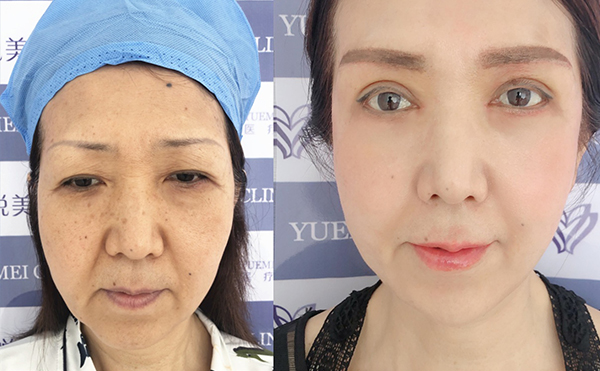 做拉皮與年齡有關(guān)嗎？