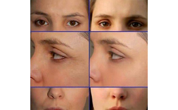 電波拉皮適合哪些人？