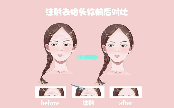 電波拉皮怎么去除抬頭紋？