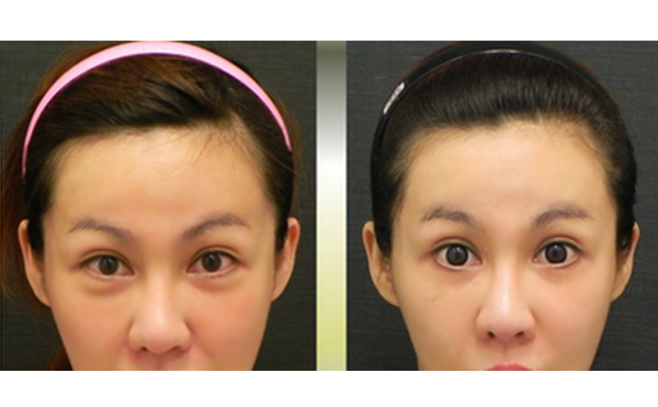 電波拉皮有副作用嗎？