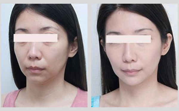 激光除皺是什么原理？