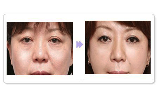 除皺針適合哪個(gè)年齡段？