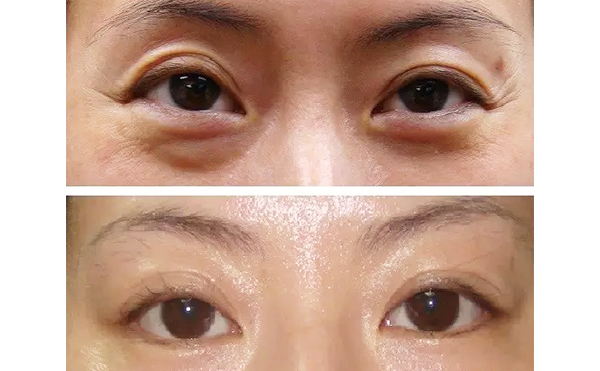 魚尾紋是怎么引起的？