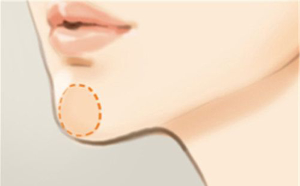 下巴整形恢復期要多久？