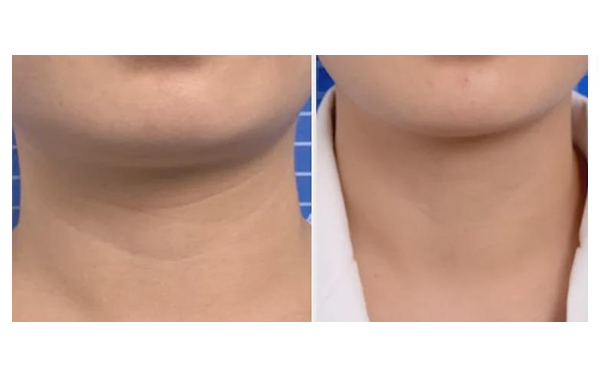 頸紋是怎么形成的？