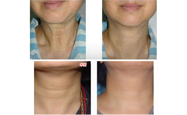 激光去除頸紋有什么優(yōu)勢？