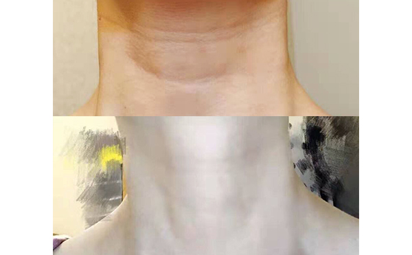 嗨體可以長(zhǎng)期使用嗎？