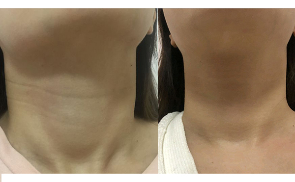 嗨體去頸紋會(huì)反彈嗎？