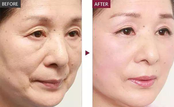 膠原蛋白除皺的適應(yīng)人群？