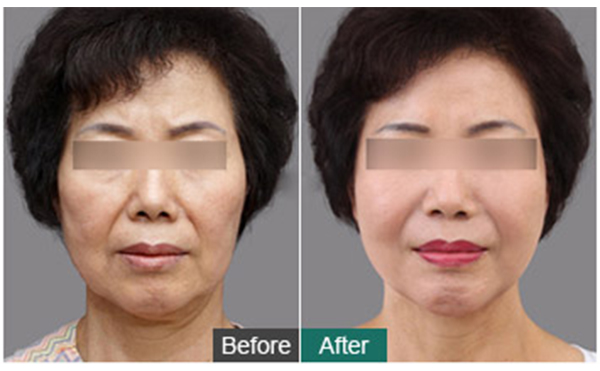 筋膜除皺提升有什么優(yōu)勢？