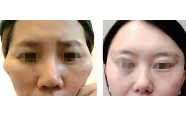 筋膜懸吊除皺有什么副作用？