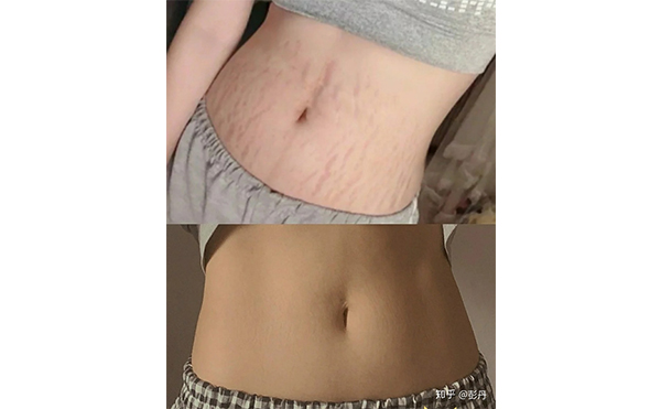 激光去妊娠紋安全嗎？