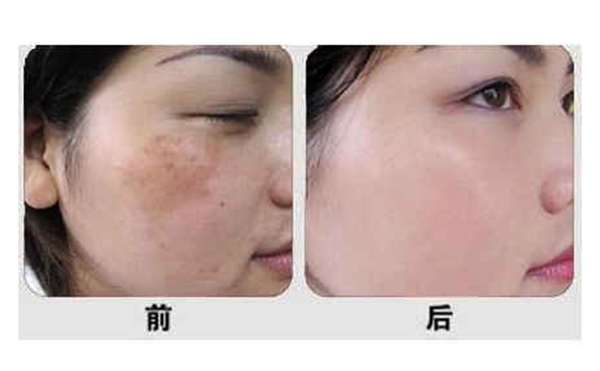 光子嫩膚有什么優(yōu)勢(shì)？