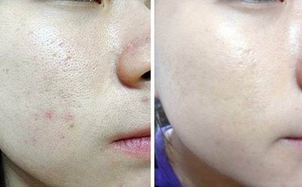 光子嫩膚的過程是什么？