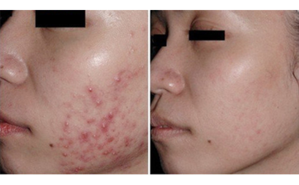 果酸煥膚好不好？