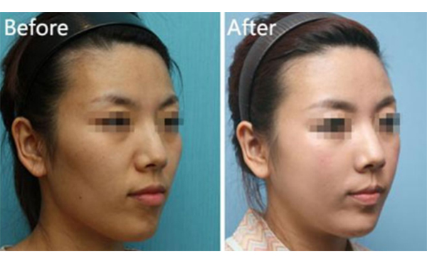 美白針一針多少錢(qián)？