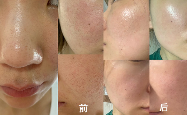 無(wú)針?biāo)庥惺裁磧?yōu)勢(shì)？