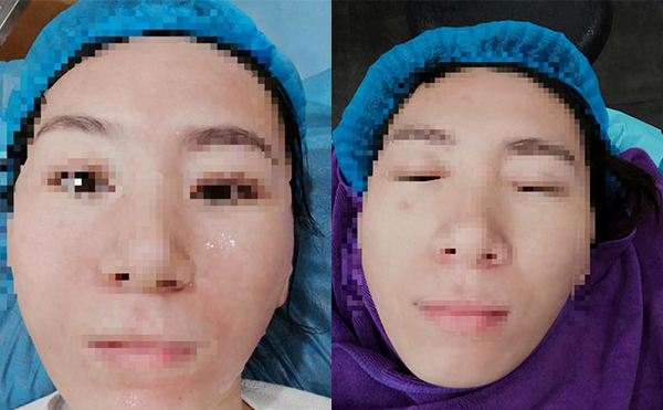 敏感肌能做水光針嗎？