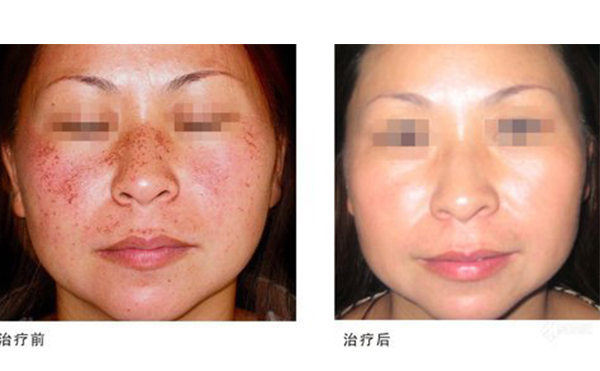 激光祛斑多少錢？