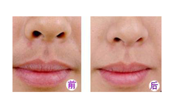 冰點(diǎn)脫毛好不好？