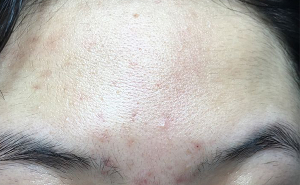 冰點(diǎn)脫毛有什么缺點(diǎn)嗎？