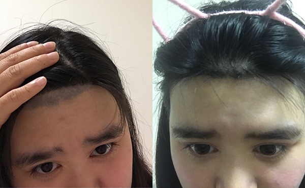 激光脫毛安全嗎？