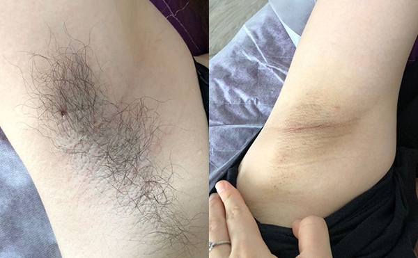 光子脫毛多少錢?價格跟哪些因素有關(guān)?