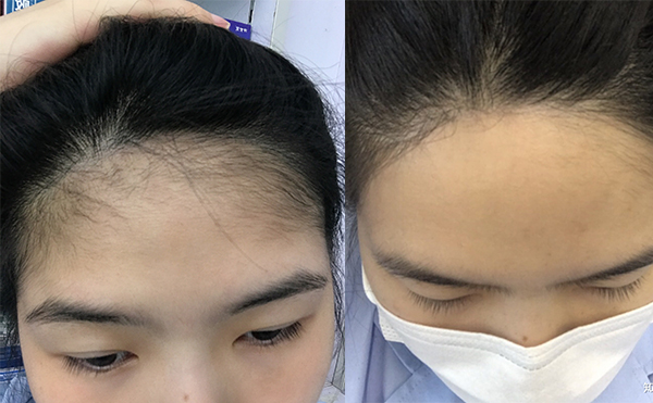 激光脫發(fā)際線的過程是什么？