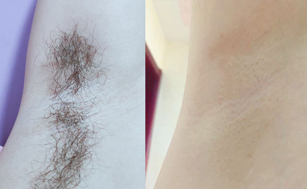 冰點(diǎn)脫腋毛要脫幾次？