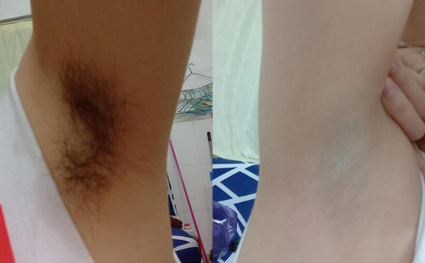 冰點脫腋毛過程是什么？