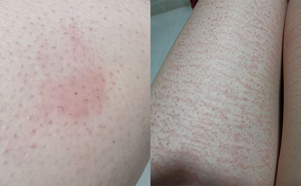 錯(cuò)誤脫毛有什么后果？