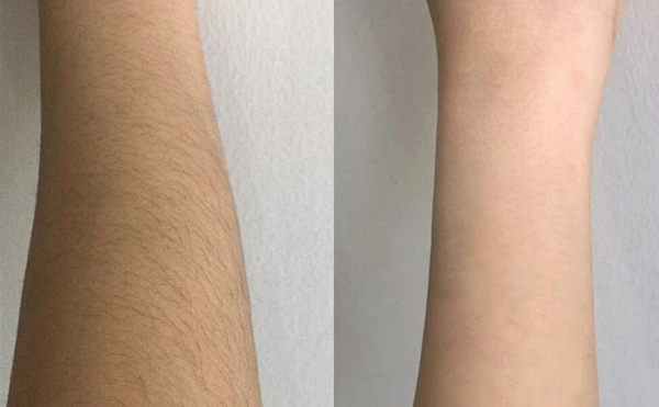 脫毛會影響新陳代謝嗎？