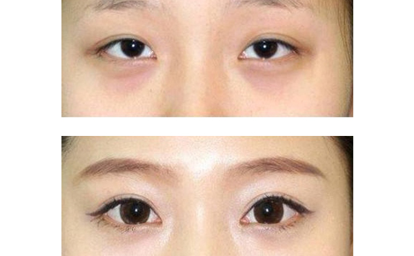 眼綜合和隆鼻可以一起做嗎？